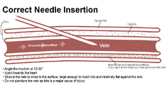 A diagram showing the angles that are optimal for I.V. injection. This image is from the "Getting Off Right Guide"[1]
