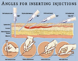 A diagram showing the different angles needed for different types of injections.